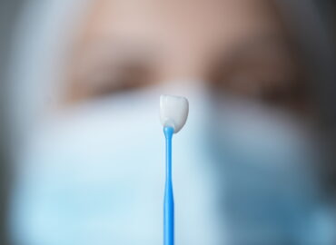 Smile Design (Veneers)